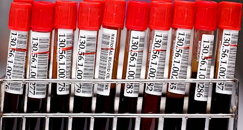 Koštana srž izliječila HIV pozitivnog pacijenta