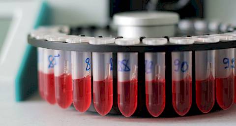 Krvni test bi mogao zamijeniti biopsiju kod dijagnosticiranja raka