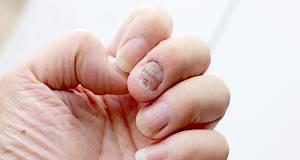 Ako primijetite promjene na noktima, možda imate ovu bolest!
