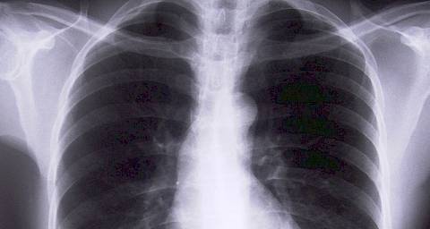 Upala pluća - u ambulantu ili bolnicu