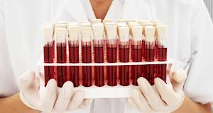 A1c test ili test glikoziliranog hemoglobina