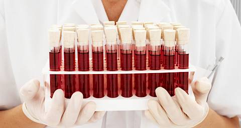 A1c test ili test glikoziliranog hemoglobina